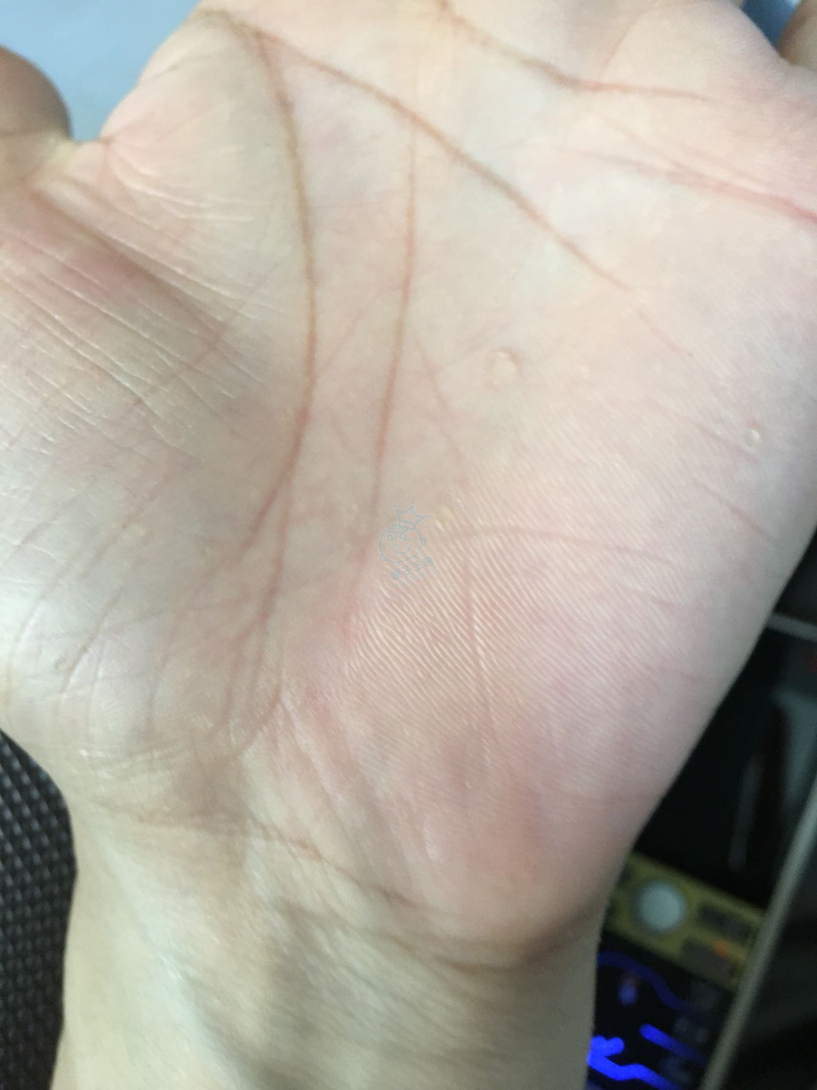 醫生話係疣唔開心吖 有圖 美容扮靚 Baby Kingdom 親子王國香港討論區