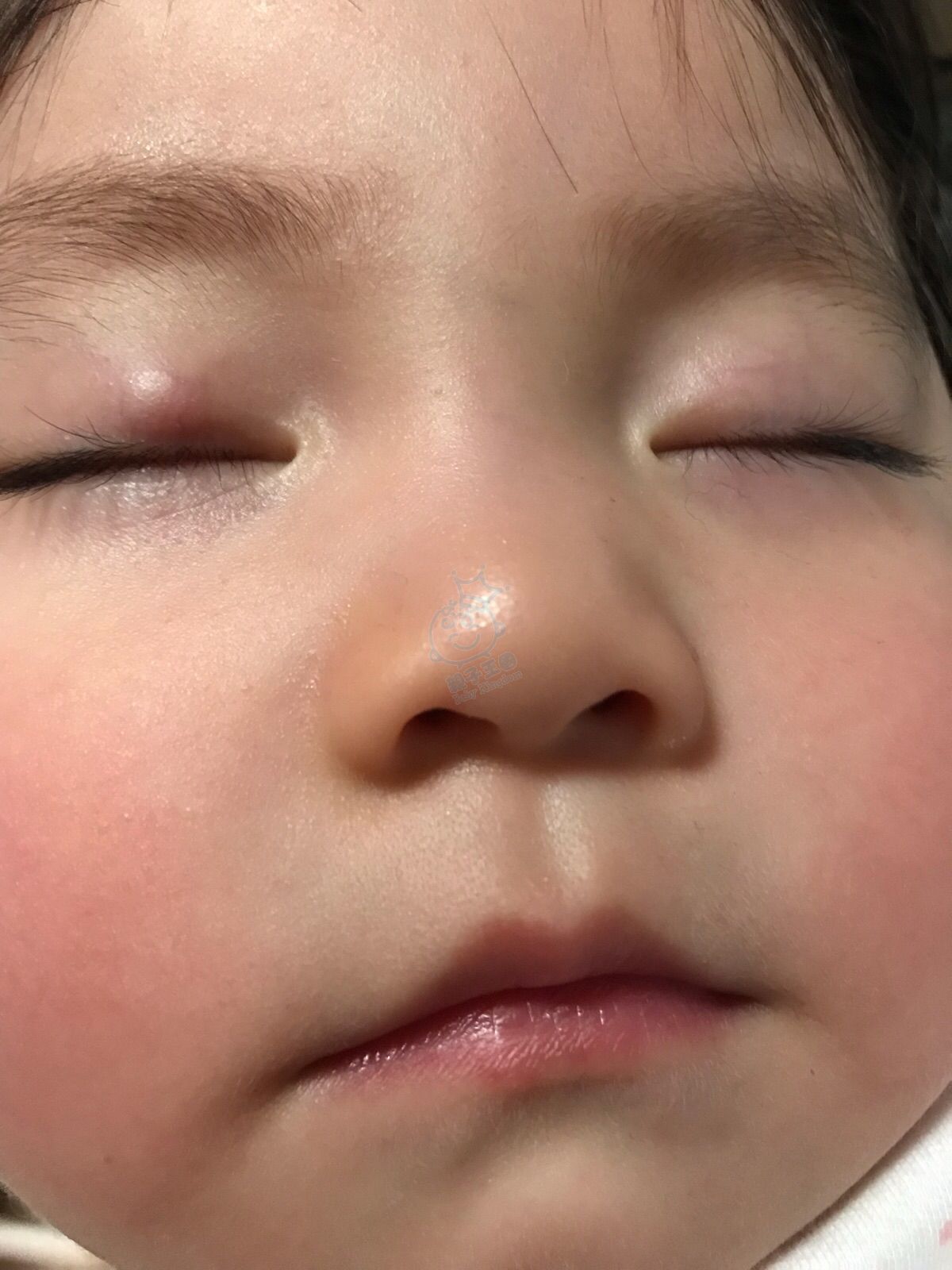 懷疑眼瘡 嬰兒醫護 Baby Kingdom 親子王國香港討論區